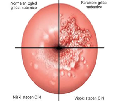 hpv vírus rak grlica maternice
